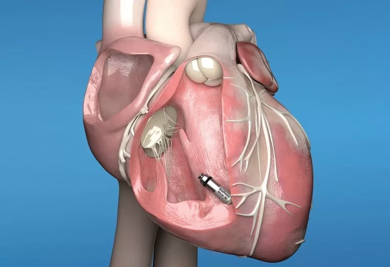 Medtronic Receives FDA Approval for New Heart Treatment